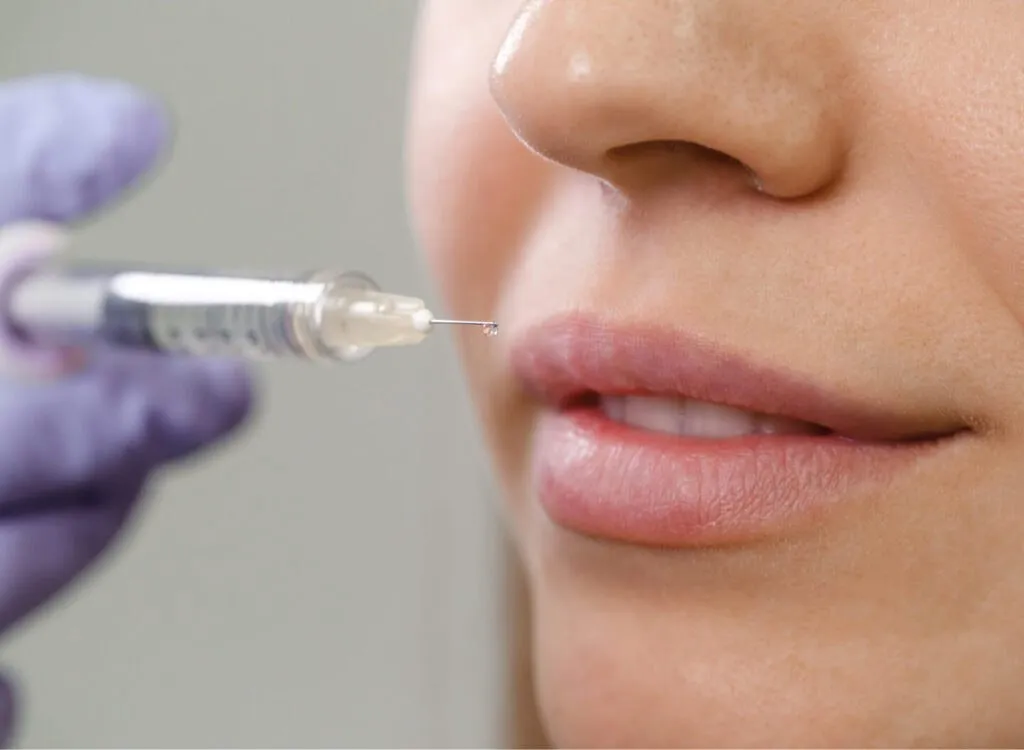 Lippenuntergespritzung mit Juvéderm Ultra in Zürich