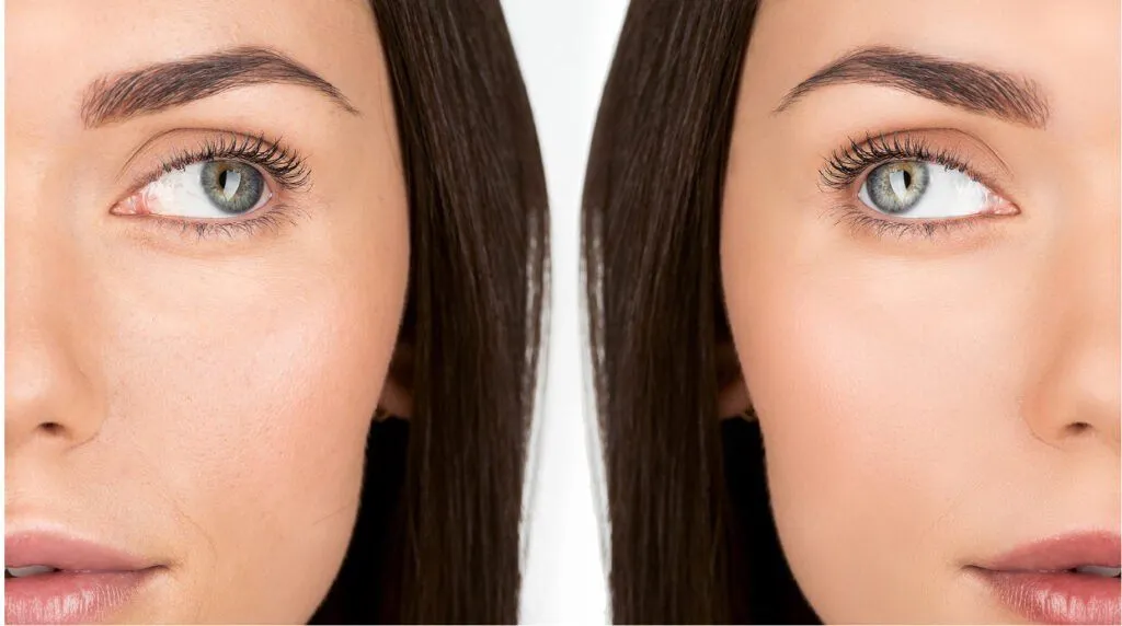 long-lasting-and-effective-results-botox-marionette-lines-1024x572